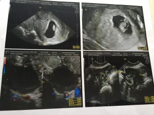 ultra de 7 semanas de gravidez