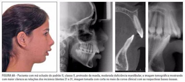 problemas-ortodonticos-infantil