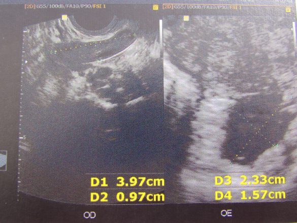 ultrassonografia-transvaginal