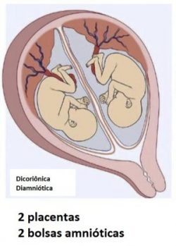 gravidez-gemelar-dicorionica-diaminiotica