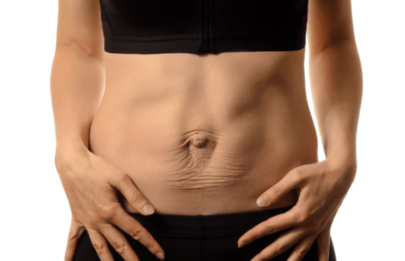 diastase-do-reto-abdominal
